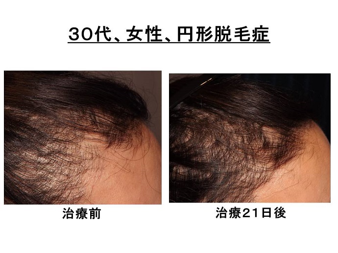 円形脱毛症　病院""